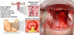 Cervical Infection