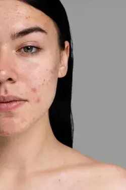 The Natural Way To Fade Acne Scars