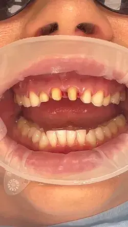 Porcelain Veneers - Kiss Dental