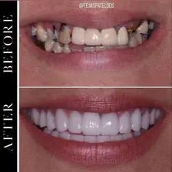 Veneer before and after