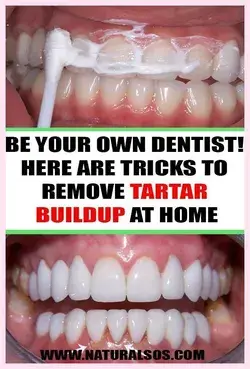 BE YOUR OWN DENTIST! HERE ARE TRICKS TO REMOVE TARTAR BUILDUP AT HOME