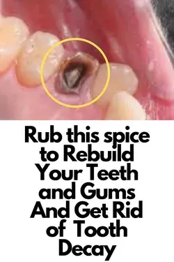 Rub this spice to Rebuild Your Teeth and Gums And Get Rid of Tooth Decay😃
