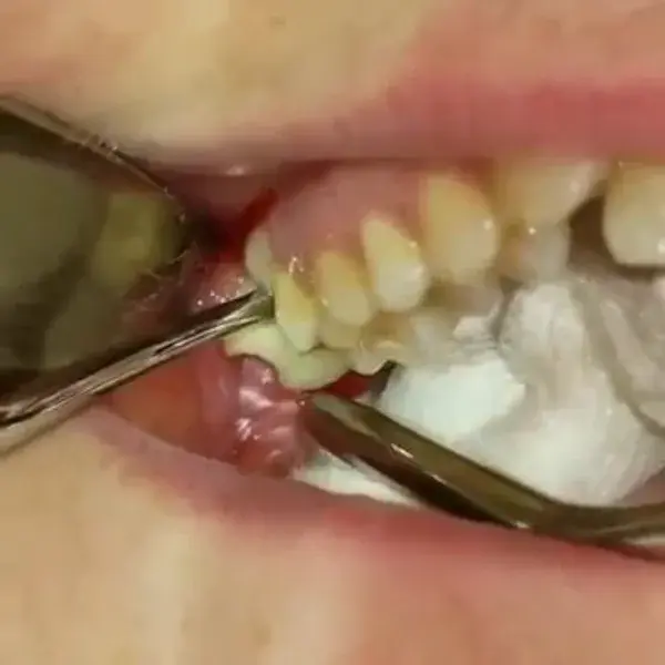 Extraction of Upper Wisdom Teeth