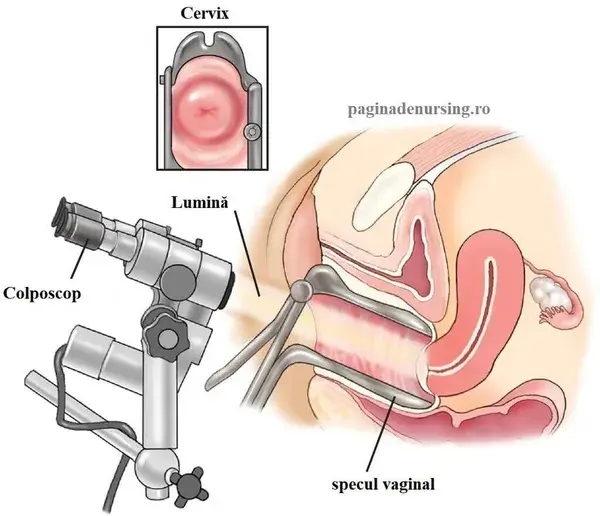 Colposcopia