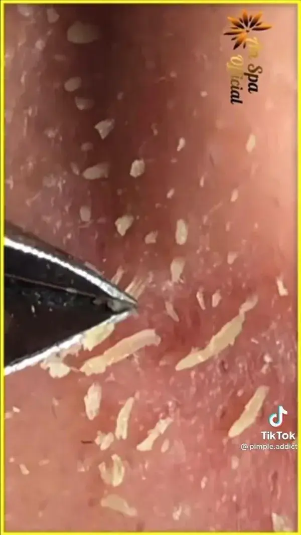 blackheads pimple remover video