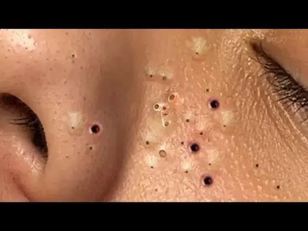 Pimple Popping | Blackheads Removal No. 71