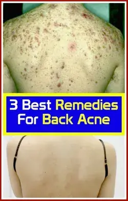 3 Best Remedies For Back Acnec