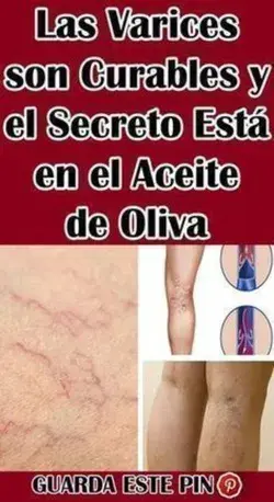 10 Remedios naturales para las varices y la circulación