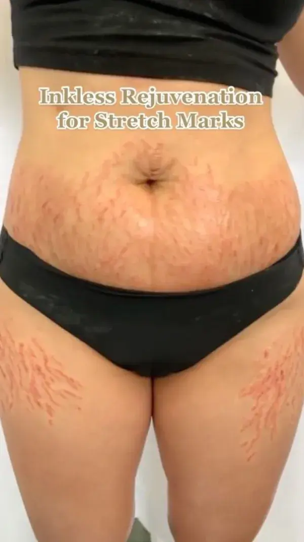 Inkless Rejuvenation for Stretchmarks