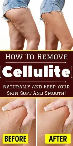 How to Get Rid of Cellulite on Thighs | Health Tips