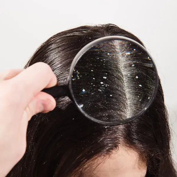 Hair Dandruff Naturally