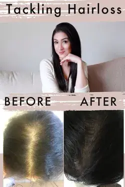 Tackling Hairloss