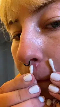 pimples removal