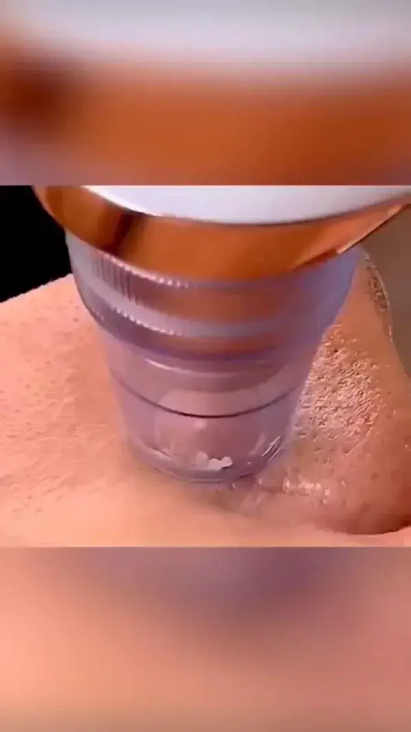 Electric Blackhead Remover!!