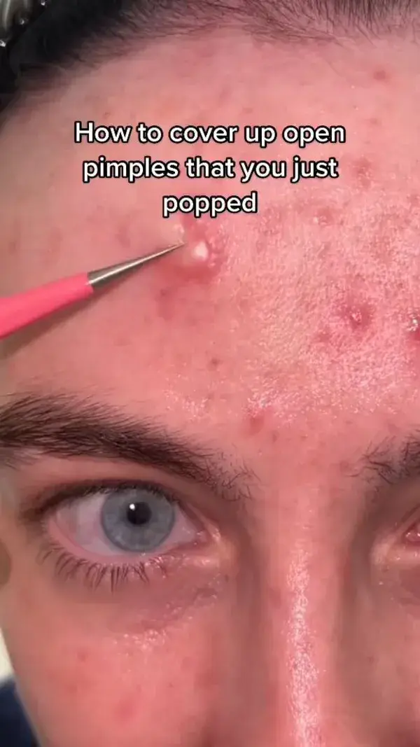 Cover up an open pimple