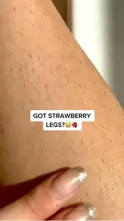 How to get rid of strawberry legs!