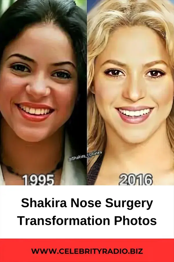 Shakira Nose Surgery Transformation Photos