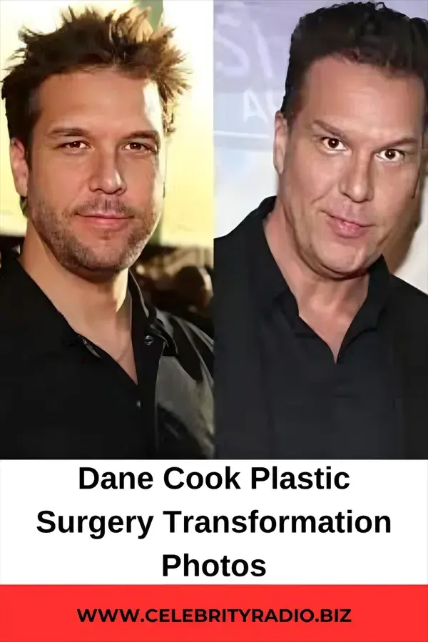 Dane Cook Plastic Surgery Transformation Photos