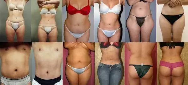 10 Common Liposuction Myths