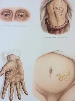 1903 Extra Large Original Antique Anatomical Poster - Skin Disease - Anatomy - Science - Dermatology - Morbid Bizarre Wall Decor