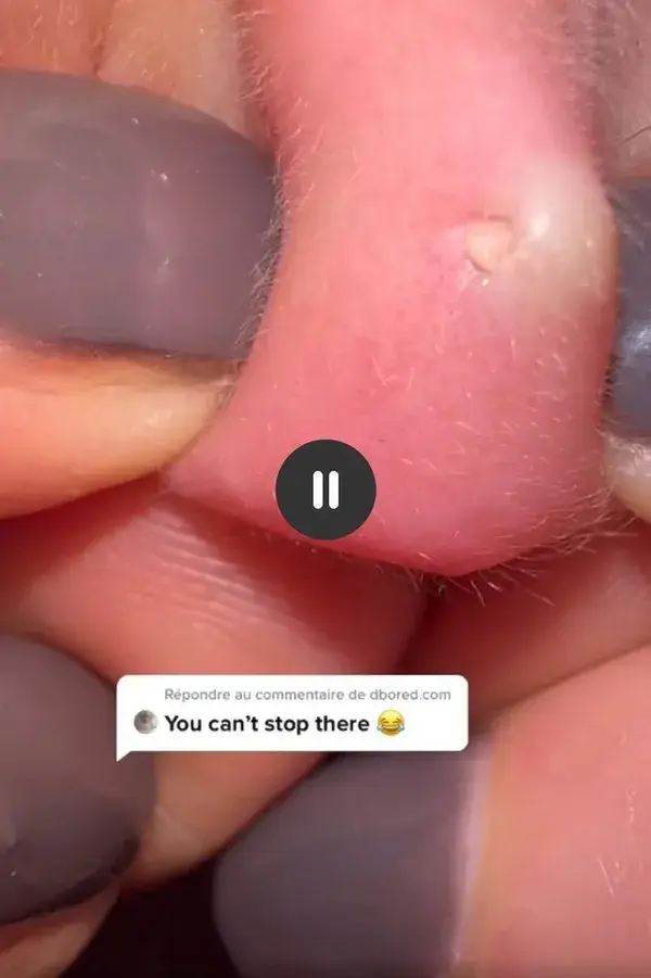 earlobes blackhead removal