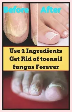 Get Rid Of Nail Fungus Forever With 2 Natural Ingredient