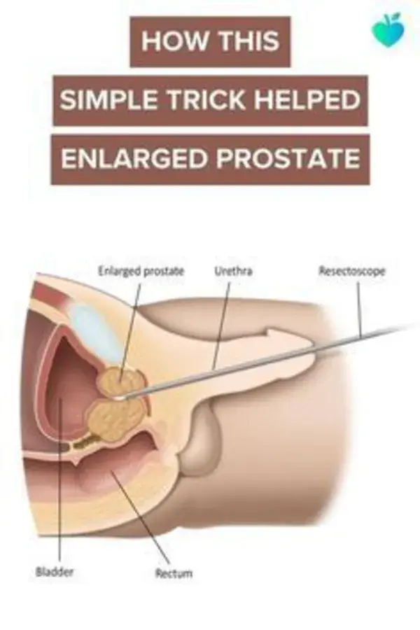 Simple Trick To Shrink Your Enlarged Prostate Faster