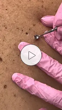 Blackhead removal