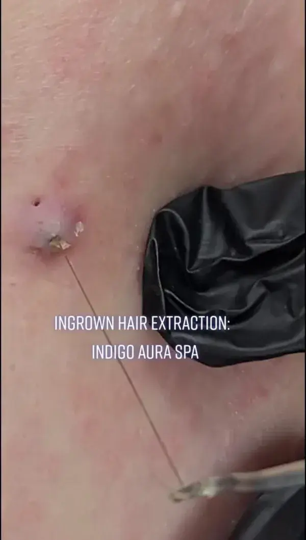 Satisfying Ingrown Hair Extraction Process😩😍