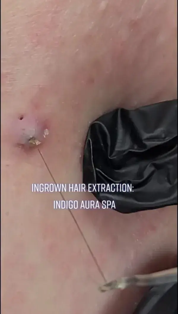 Blackhead removal