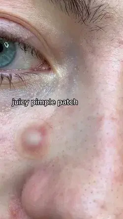 Juicy pimple patch