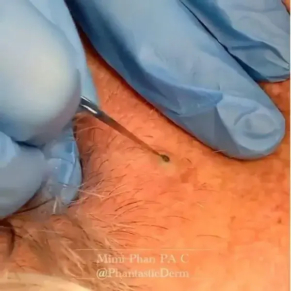 Blackheads removal so satisfying