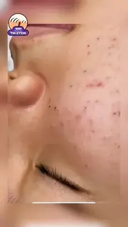 #acne #blackhead #pimple #satisfying #squeezepip #blackheads ZERTT