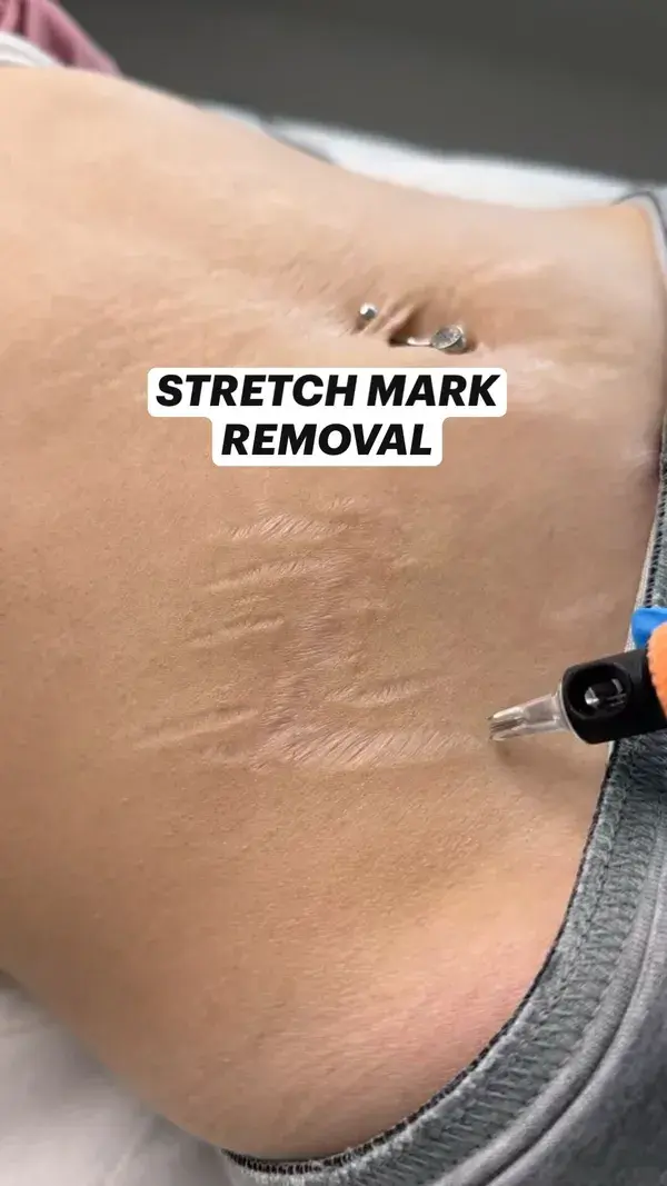 Saying Goodbye to Stretch Marks: Effective Tips for Removal