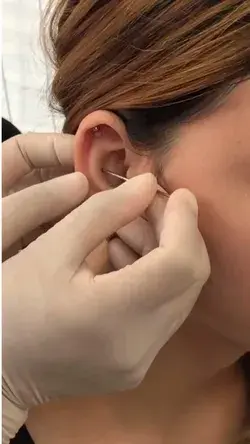 Heal PIERCING BUMPS Fast!