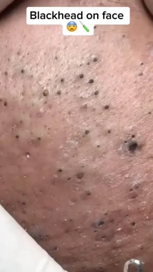 Crazy amount of blackheads on face satisfying blackhead extraction