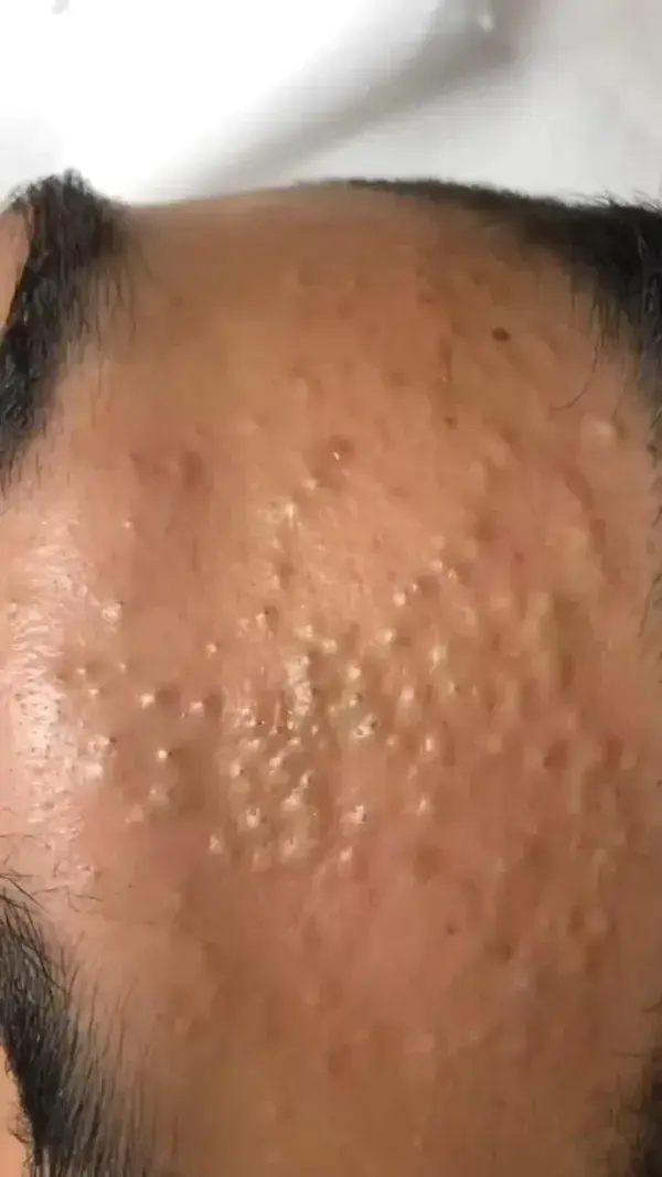 Blackheads