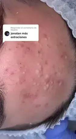 Blackheads