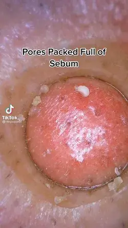 pimples blackheads removal extraction