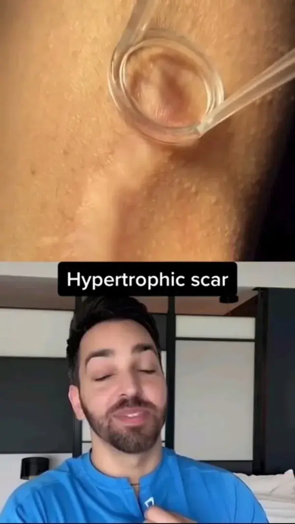 hypertrophic scar treatment