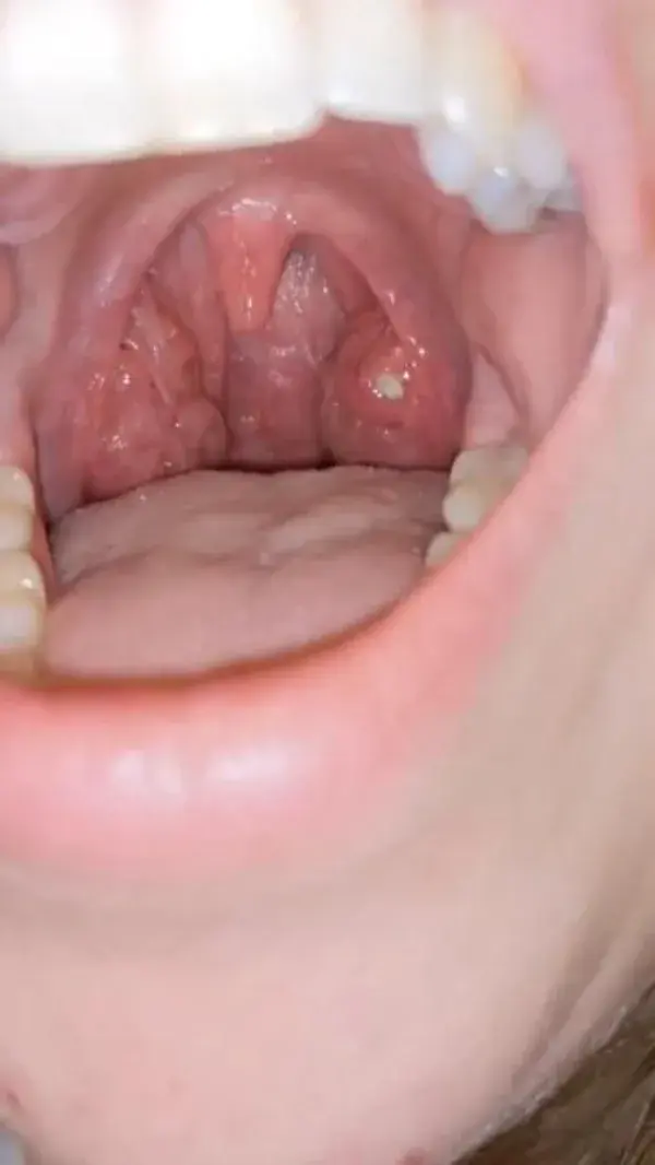 REMOVE YOUR TONSIL STONES WITH THE RIGHT TOOL
