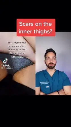 Inner thigh scars treatment 💓👏🏽