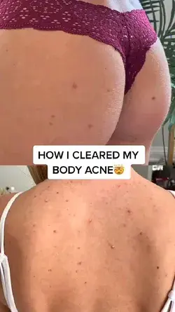 How I Cleared my Body Acne!