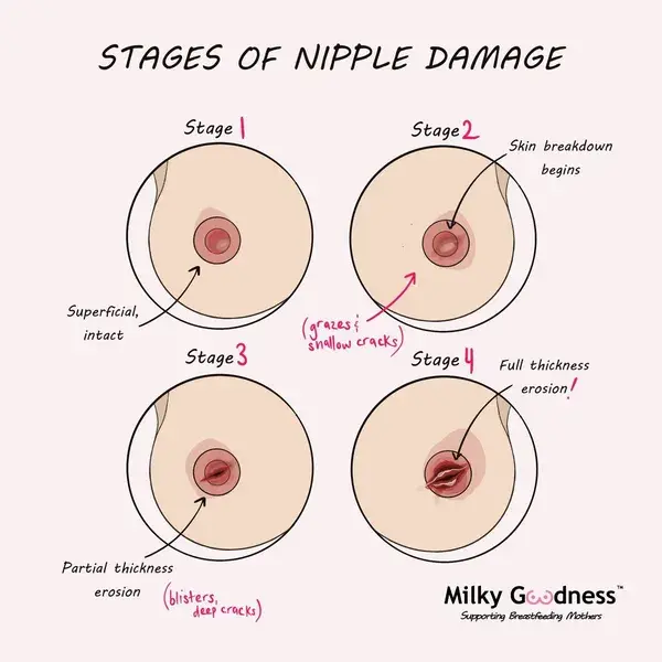 Nipple damage and breastfeeding