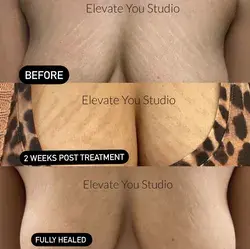 Healing process of Stretchmarks Inkless Tattoo