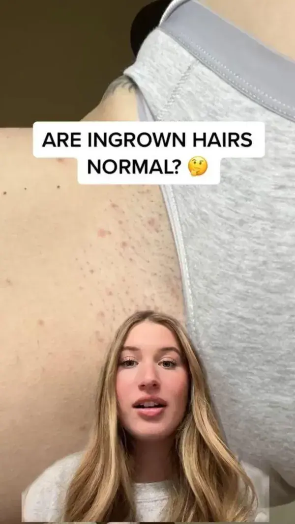 Are Ingrown Hairs Normal?