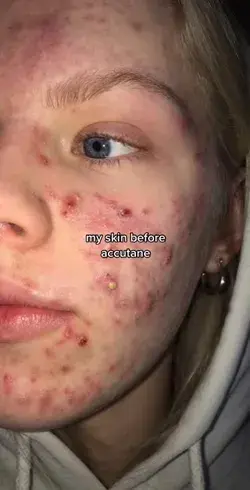 Crazy Acne Transformation😨