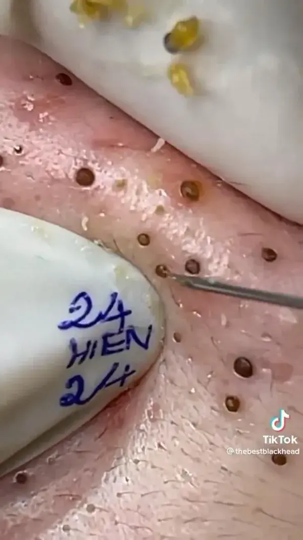 Blackheads extraction