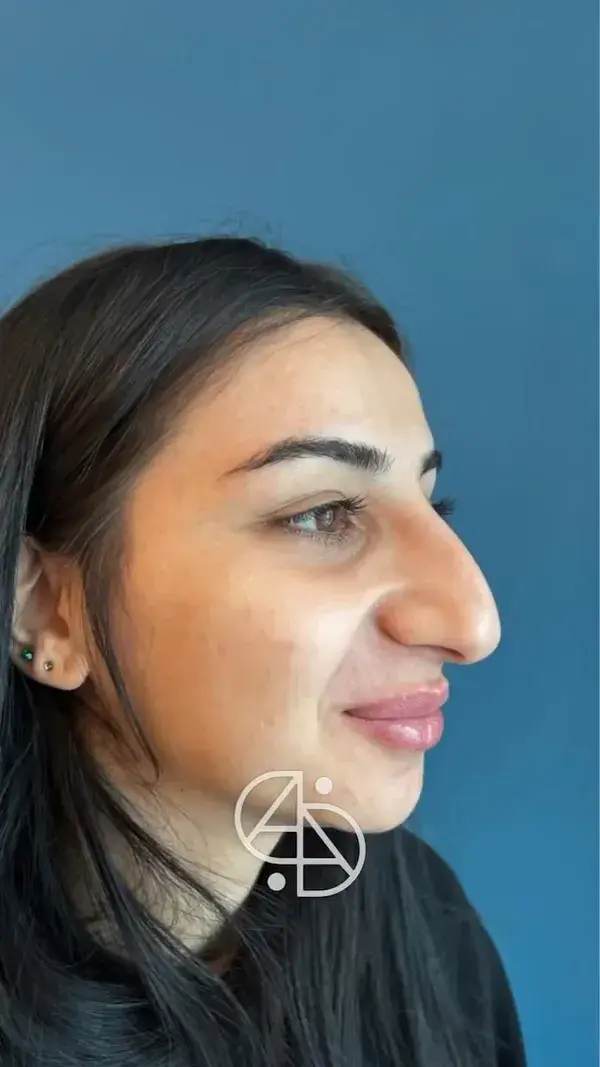 Rhinoplasty Result - Dr. Ahmet Dilber