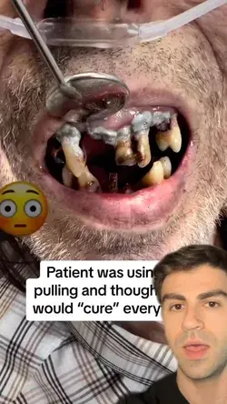 Oil Pulling DESTROYED His Teeth #dentist #teeth #tooth